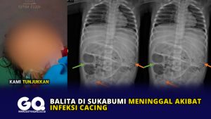 Balita di Sukabumi Meninggal Akibat Infeksi Cacing